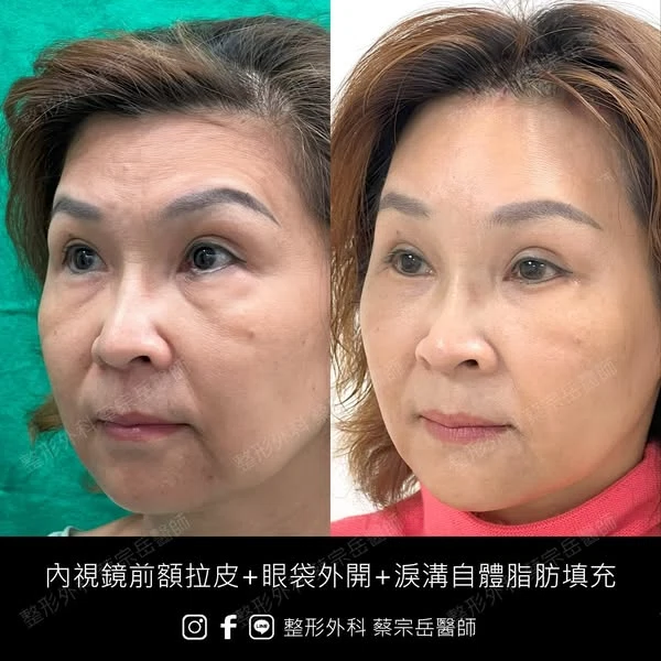 內視鏡前額拉皮+眼袋外開+淚溝自體脂肪填充