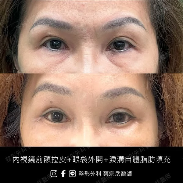 內視鏡前額拉皮+眼袋外開+淚溝自體脂肪填充